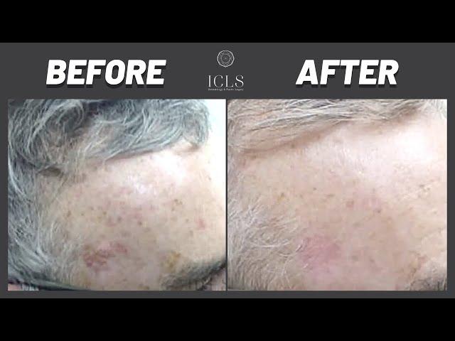 Sun Damage Removal Treatment | Skin Spa Specialist for Skincare | ICLS Dermatology & Plastic Surgery