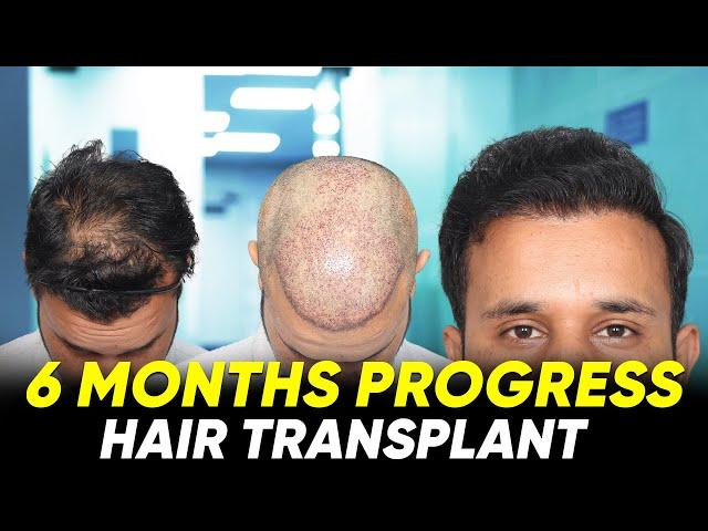 Hair Transplant in Chennai | Best Results & Cost of Hair Transplant in Chennai