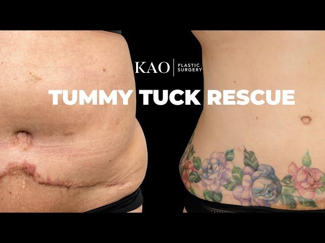 Tummy Tuck Rescue - Tummy Tuck With 360 Sculpt Liposuction - KAO Plastic Surgery - Graphic Content