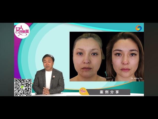 余亚暻医学博士分享面部塑形案例 | 维美整形外科|精彩呈现面吸脂、颊脂垫去除、脂肪填充技术 完美塑造太阳穴、眉弓、眉眼鼻与下颌线|打造标志性美人凹|专为追求美丽的您|HOW视频系列《女人我最美》