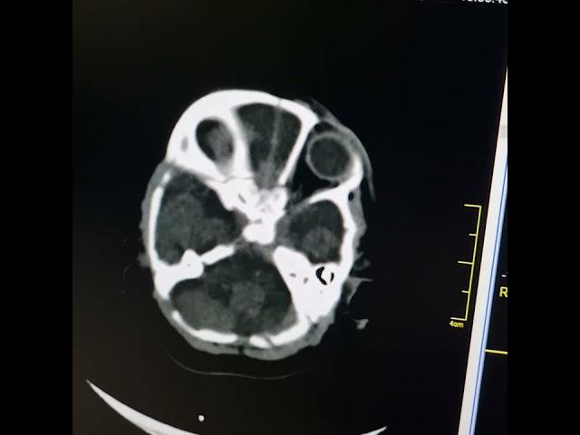 Corpus Callosal agenesis, Pachygyria and Schizencephaly.