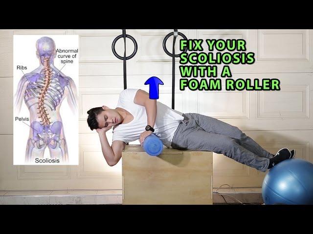 Fix Your Scoliosis with a Foam Roller (Scroth's Method)