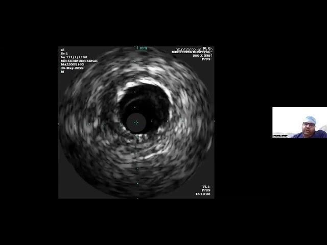 Dr. Raghav Sharma: Bifurcation stenting in Left Main CTO | Sessions @Acardmy