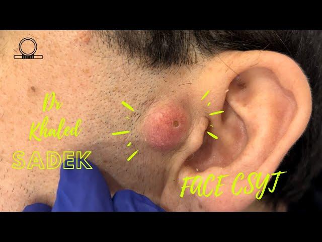 Massive Face Blackhead Extraction with Dr Khaled Sadek , LipomaCyst.com