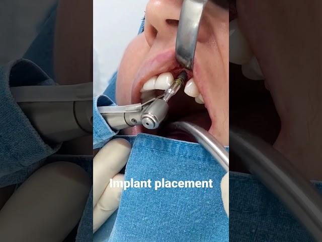 Full Implant placement procedure link in description #dentist #implant #teethtalk  #dentalimplants