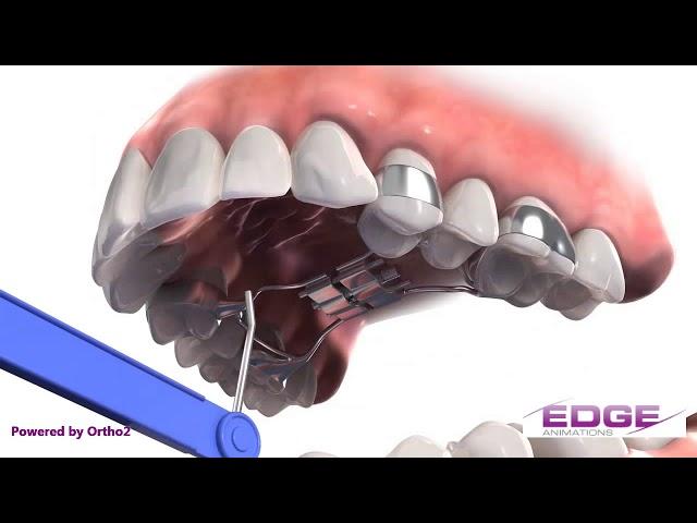 Turning your palatal expander