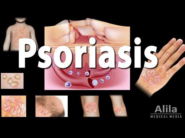 Psoriasis: Types, Symptoms, Causes, Pathology, and Treatment, Animation