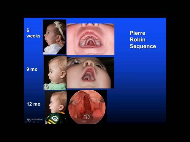 Mount Sinai Dept. of Otolaryngology Cleft Lip & Palate State of the Art & Science 4-16