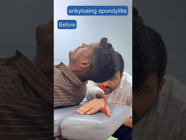 ankylosing spondylitis before and after chiropractic adjustment #trend #feed #feedshort #ytviral