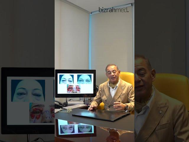  Blepharoplasty (Eyebags Removal): Before and After Results by Dr. Bizrah | Bizrahmed Center 