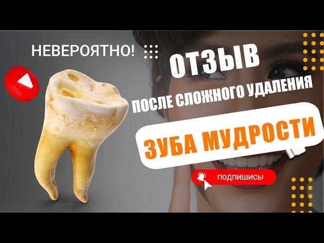 Отзыв после сложного удаления зуба мудрости. Удаление зуба мудрости - процедура в стоматологии.