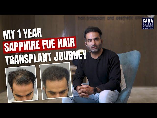 The Journey to Happiness: 1 Year of Hair Transplant Success