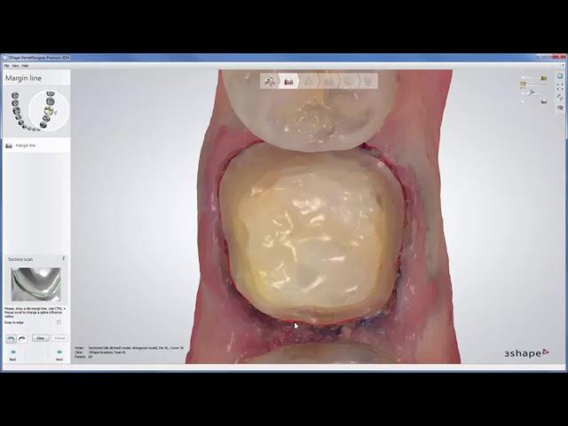 3Shape Dental System - Full Anatomical Crown on TRIOS Scan