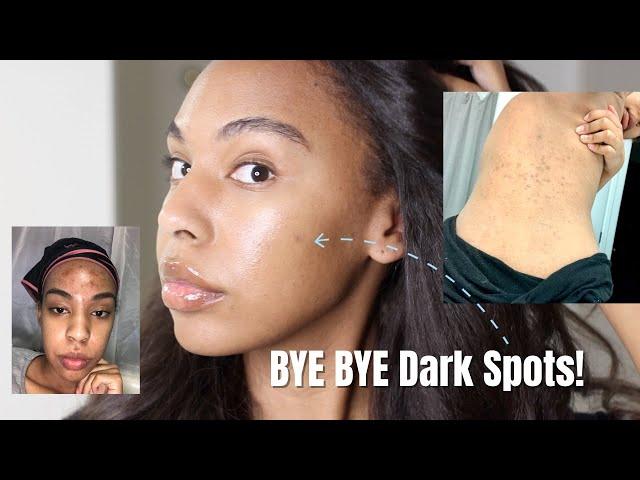 How to Get Rid of Dark Spots Hyperpigmentation! The safe way!