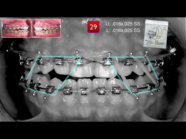 Philosophies in Finishing｜【Chris Chang Ortho】CC491