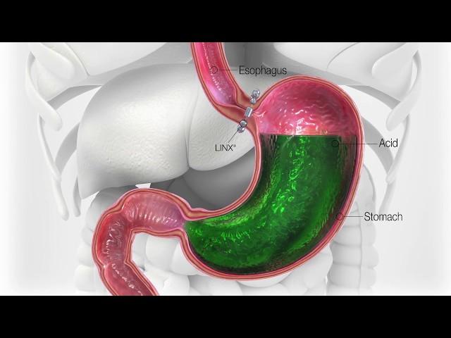 New Surgical Procedure to Help Cure Acid Reflux