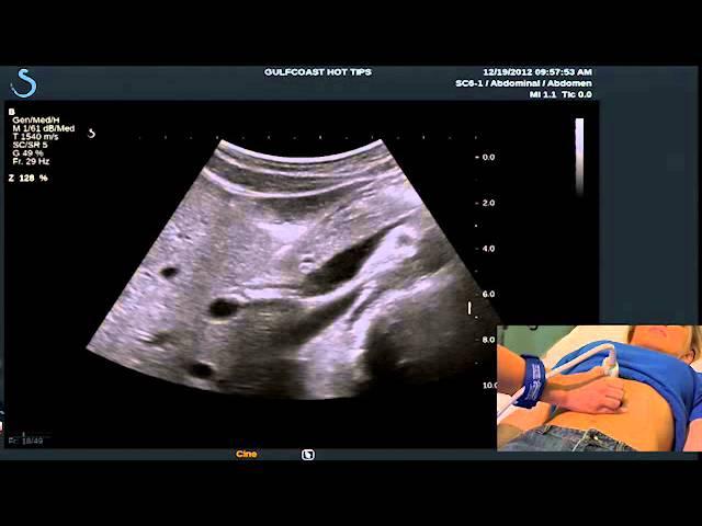 Hot Tips - Locating the Common Bile Duct with Ultrasound