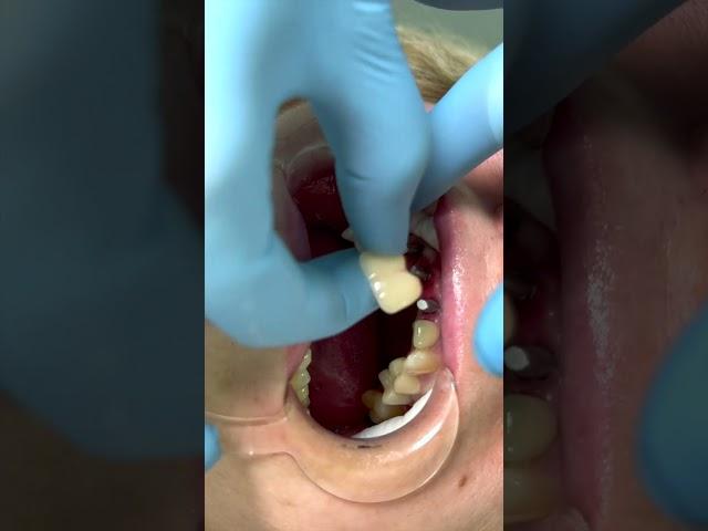 Fixation of crowns on dental implants