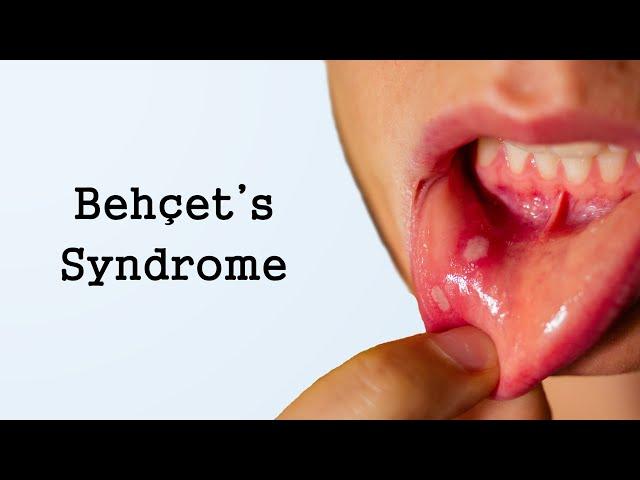 Behcet's Syndrome