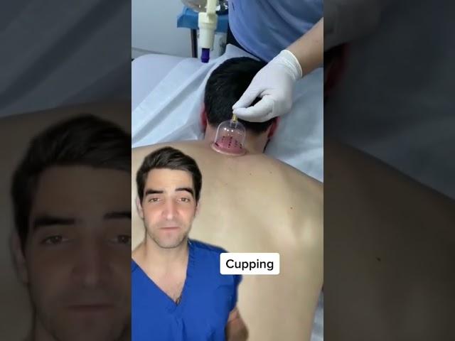 Cupping, does it work?