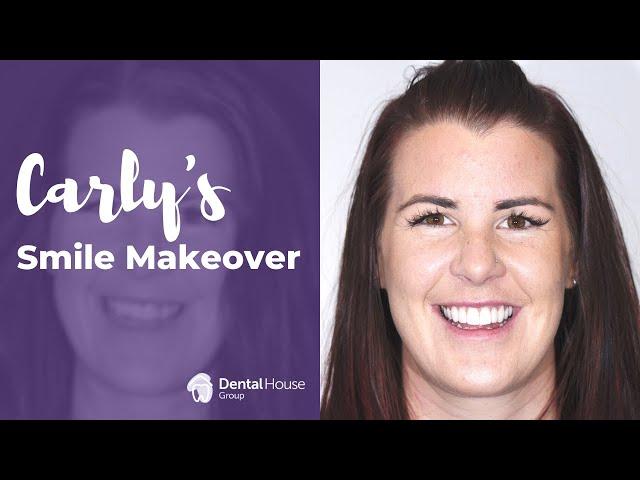 Carly Porcelain Veneers and Crowns in Melbourne