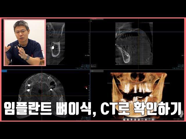[대전 투명교정, 대전 임플란트] 임플란트 뼈이식, CT로 확인하기