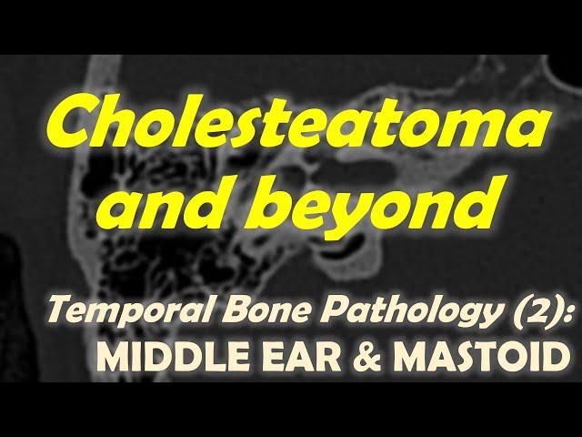 Temporal Bone Imaging (2): Middle Ear Disease