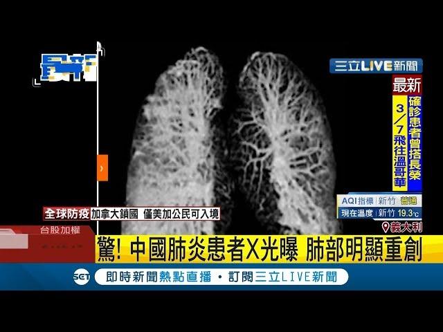 中國肺炎患者X光照片曝光...肺部明顯重創！ 義大利報紙訃聞"整整10頁"｜記者 程思瑋｜【國際大現場】20200318｜三立新聞台