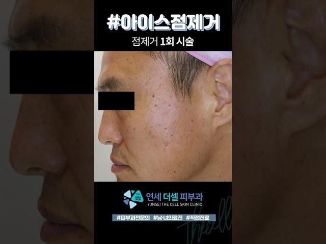 점제거 점빼기 시술 후 5주 경과 전/후 영상  점뺀 후 관리와 효과까지! 지우개로 지우듯 없어지는 점! #아이스점제거 #점제거#shorts