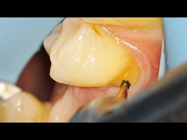 Filling a Cavity: Can Gumline Decay be Fixed with Tooth Colored Fillings?