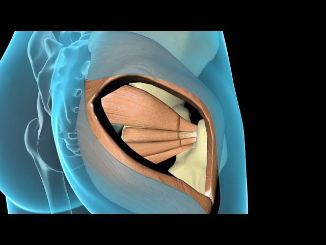 Total Hip Replacement
