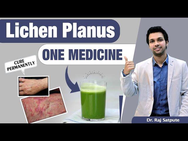 One Medicine To Cure Lichen Planus Skin Disease Naturally & Permanent *Results From First Week*