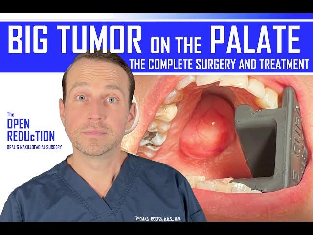 BIG TUMOR on PALATE: the FULL SURGERY