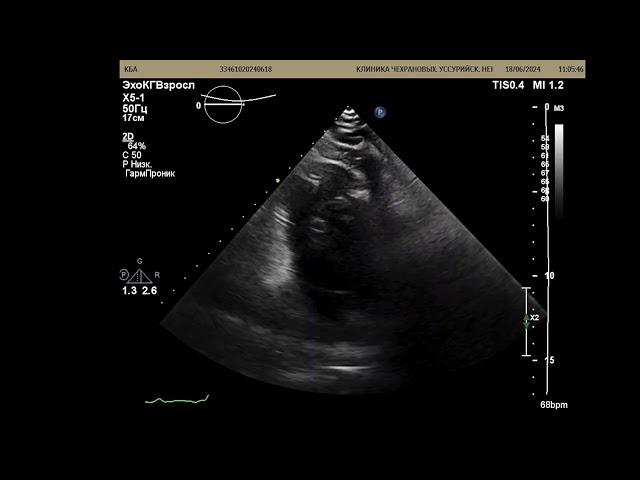 Перенесенный инфаркт. УЗИ сердца