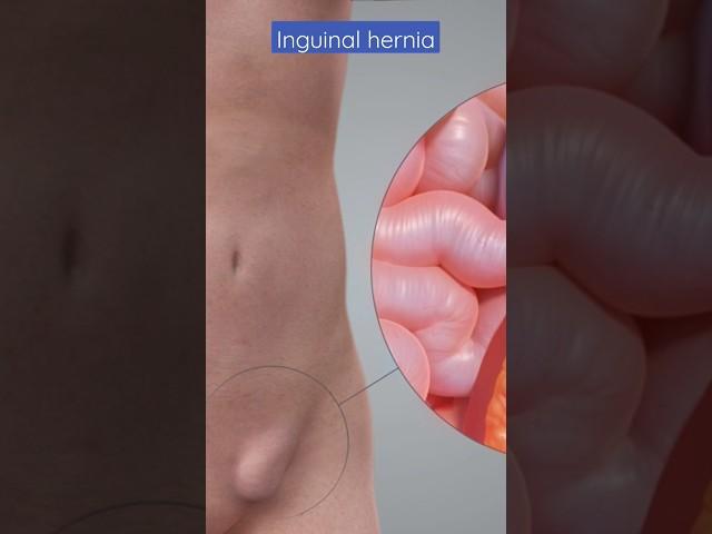 Inguinal hernia I Inguinal hernia treatment in Delhi @DrAshishSachan