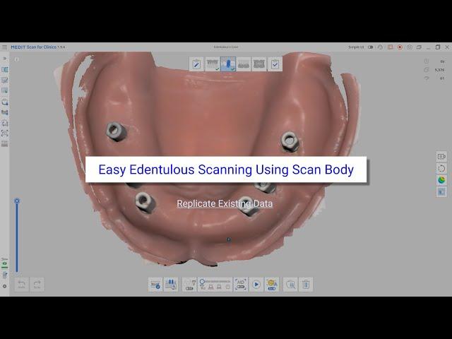 Easy Edentulous Scanning Using Scan Body (Replicate Existing Data)