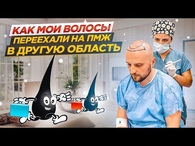 ПЕРЕСАДКА ВОЛОС на Северном Кипре КАКОВО ЭТО?! | Метод FUE личный опыт КИПРИОТИКИ
