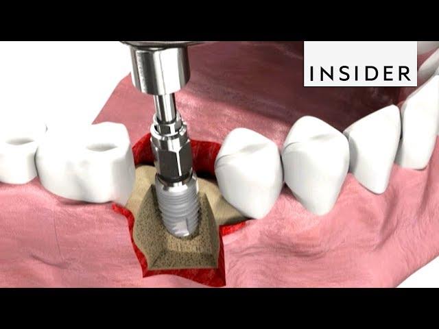 How Dentists Insert Dental Implants