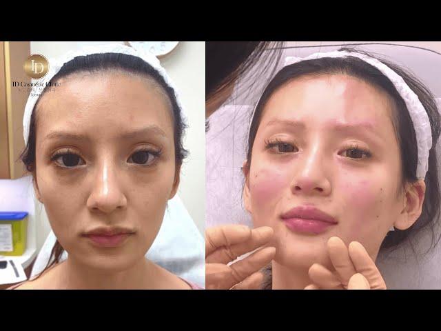 改变病弱刻薄感面相｜徐医生素人改造计划｜ID医美诊所 ID Cosmetic Clinic