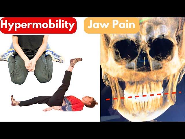 Jaw Pain and Hypermobility (Is it ALL connected?)