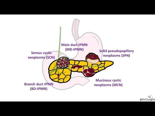 Cystic Neoplasms of Pancreas