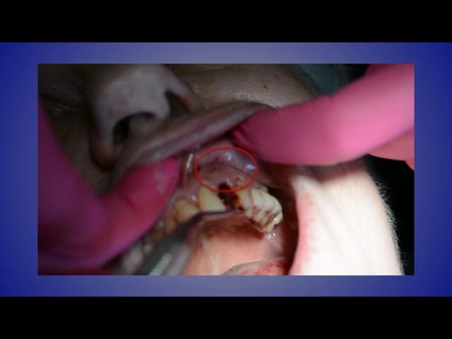 Case of the Week: Immediate Extraction and Implant Placement