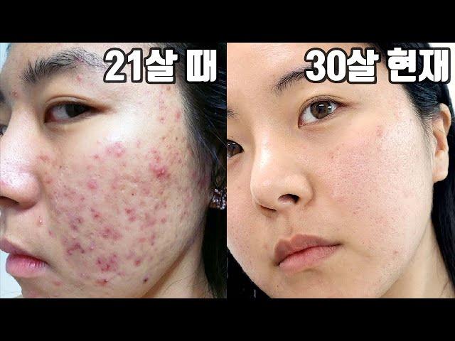 REALIZED through 30 years of experiencing acne Characteristic of hyperpigmentation and how to get