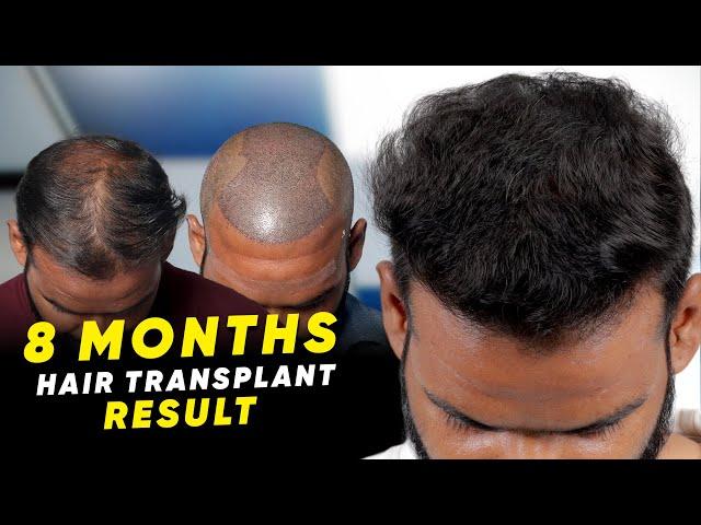 Hair Transplant in Chennai | Best Results & Cost of Hair Transplant in Chennai