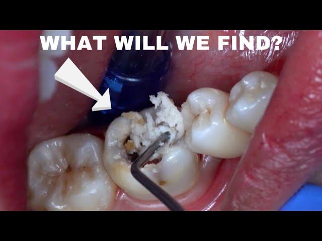 A Very BIG and DEEP Cavity | Dental Caries | Dentist | Dokter Gigi Tri Putra