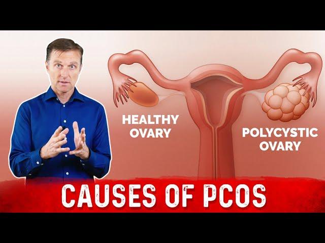 3 Causes of Polycystic Ovarian Syndrome (PCOS) & High Androgens – Dr. Berg