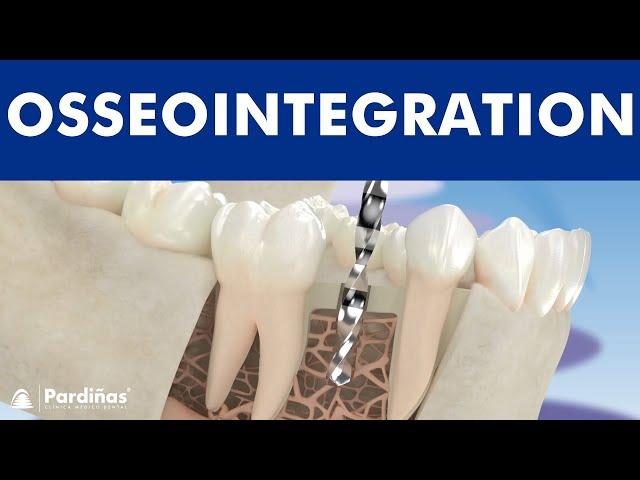 How does an implant work? Osseointegration of dental implants ©