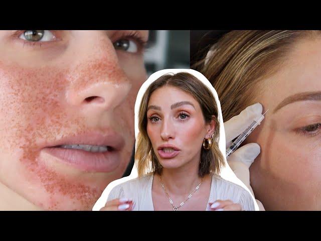 THE TRUTH BEHIND MY FACE | Botox, Fillers, Laser