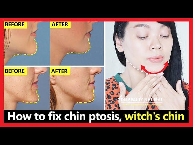 How to fix chin ptosis, witch's chin, chin correction, chin long, get beautiful chin without surgery