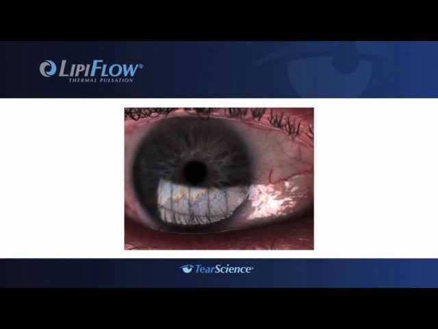 Lipiflow - Dry Eye Therapy at the Gavin Herbert Eye Institute, UC Irvine